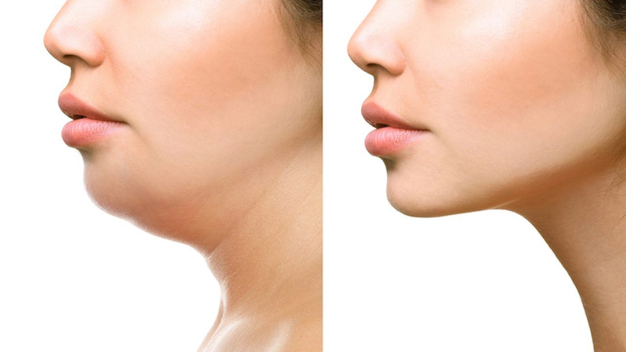  Естетика на двойната брадичка: Endolift или Vaser Liposuction? 